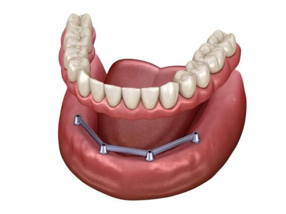 Herausnehmbarer Mandibulärer Zahnersatz Herausnehmbarer Mandibulärer Zahnersatz